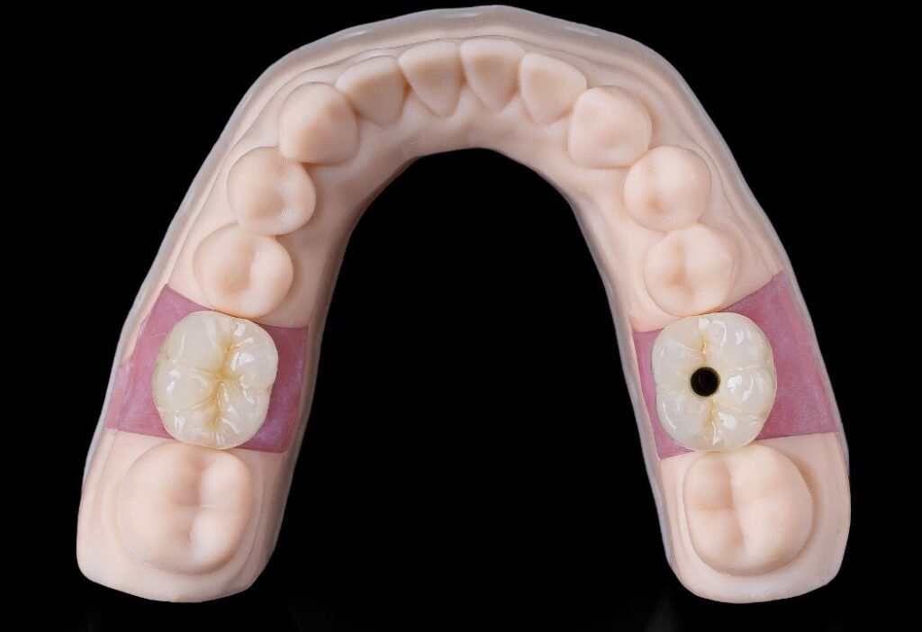 Cement-Retained & Screw-retained Implant