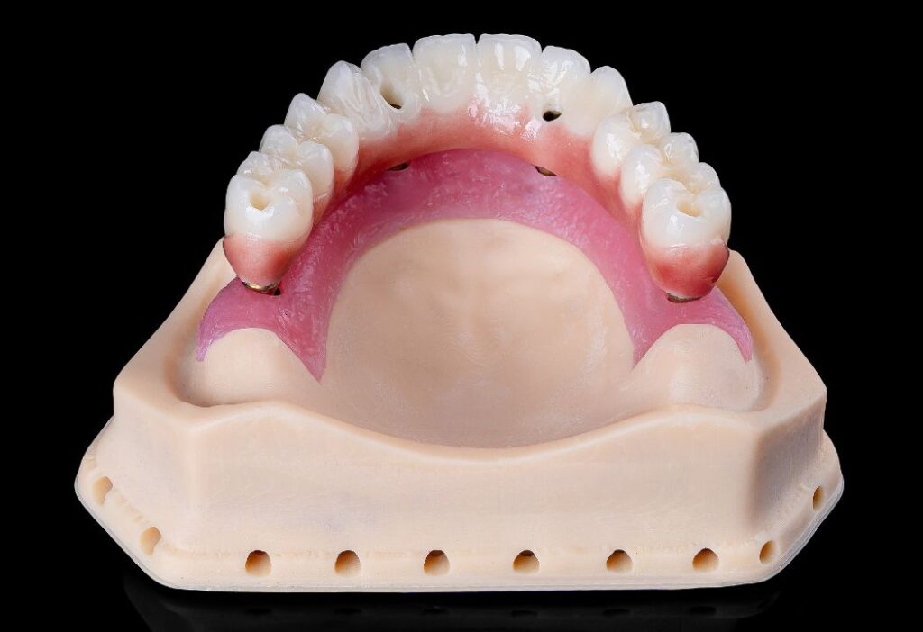 Screw-retained Implant