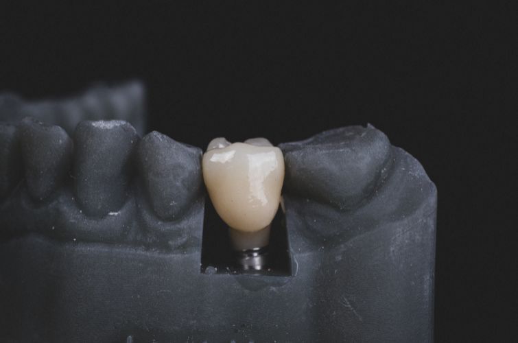 CoCr PFM crown on Implant
