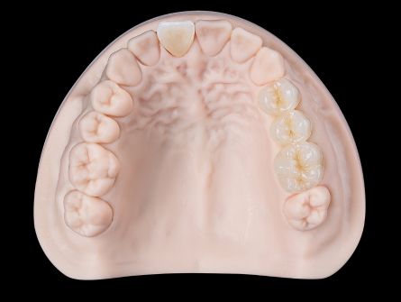 Porcelain-Fused-to-Metal (PFM)