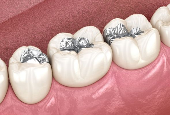 Avantages de la couronne PFM métal occlusal