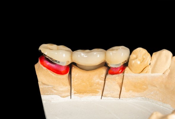 Vantaggi clinici della corona PFM con collare metallico