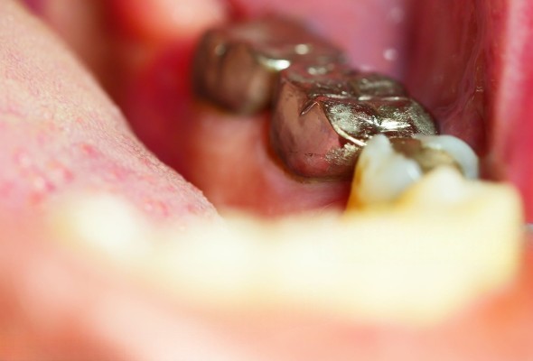 Applicazioni cliniche della corona PFM con collare metallico