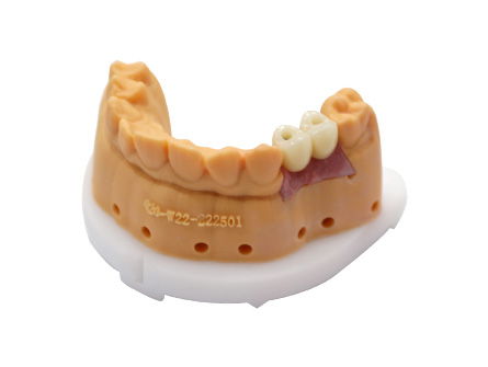 Kosmetische Zahnimplantate