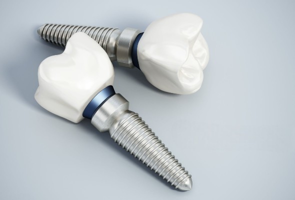 Individuelle Abutments für PFM-Implantatkronen