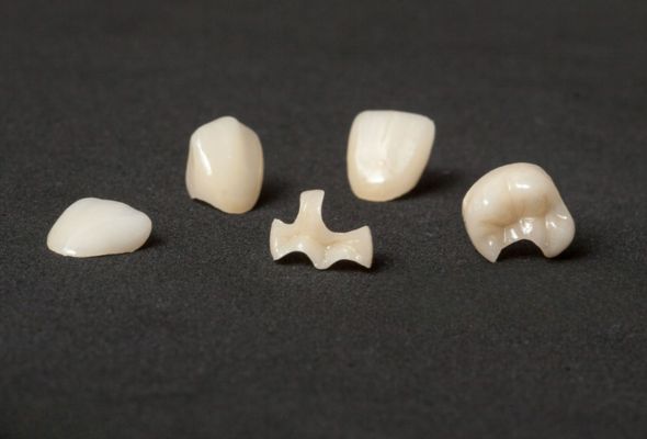 Precision Dental Inlays and Onlays | Istar Dental Lab