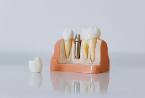 Digital Dental Implant Dental Lab