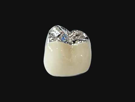 Digital Porcelain Fused to Metal Crown