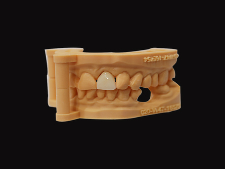 Digital Quality Layered Zirconia Crown