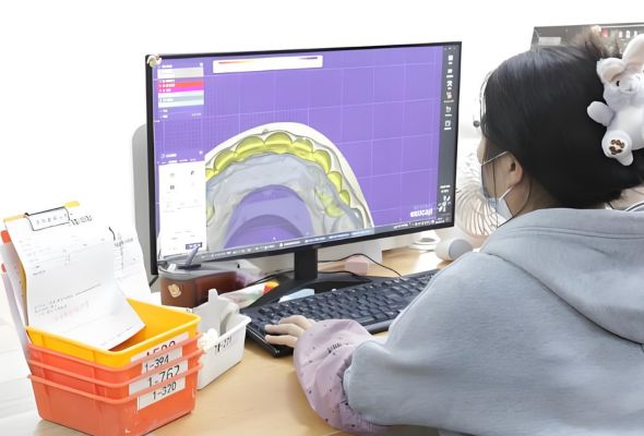 Couronne Emax du laboratoire dentaire Istar à l'aide de l'impression numérique