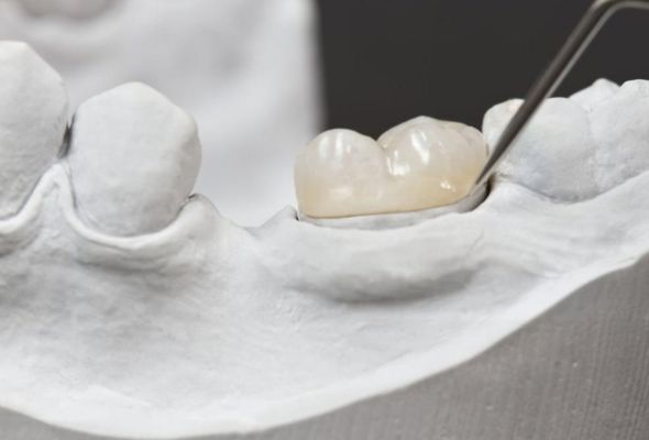 Удължаване на живота на PFM коронките