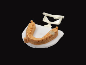 Corona de circonio de contorno completo