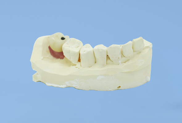 Couronne d'implant (2)