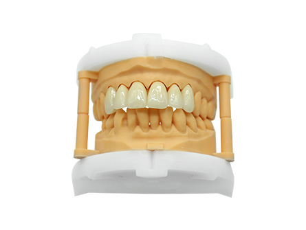 Geschichtete Zirkoniumdioxid-Krone