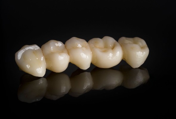 PFM Posterior Bridges