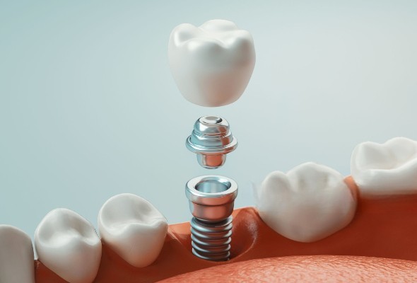 Retentionsmethoden für PFM-Implantatkronen