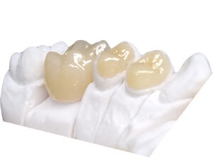 Inlay en zircone Onlay