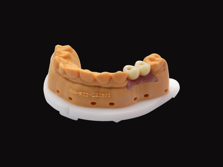 implantes dentales asequibles y estéticos