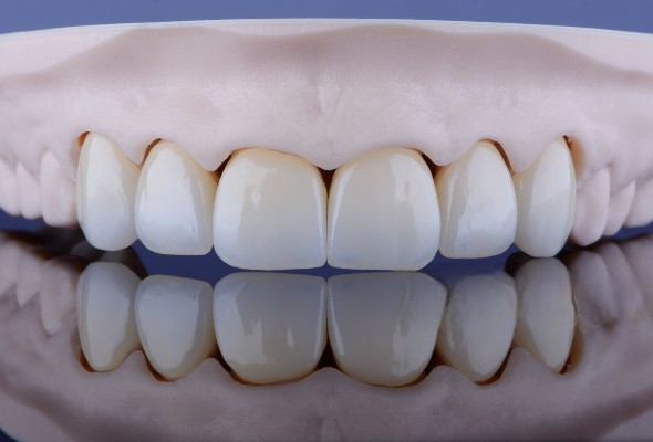 Eccellenza estetica delle corone anteriori in PFM