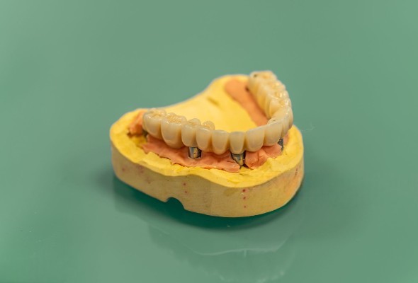 Решения за зъбни импланти All-on-X Zirconia