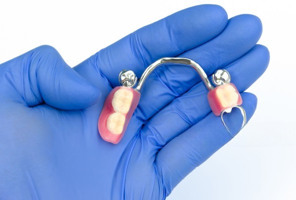 Applications cliniques des prothèses partielles Vitallium