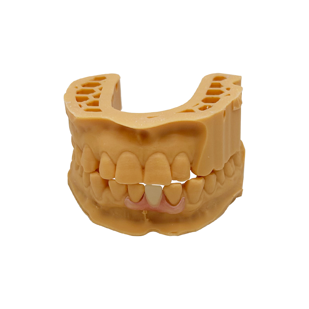 Dentures-With-Clasps-(3)