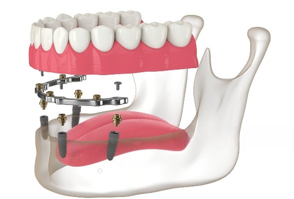 Udforsk Istar's udvalg af implantatløsninger til øvre og nedre tandproteser