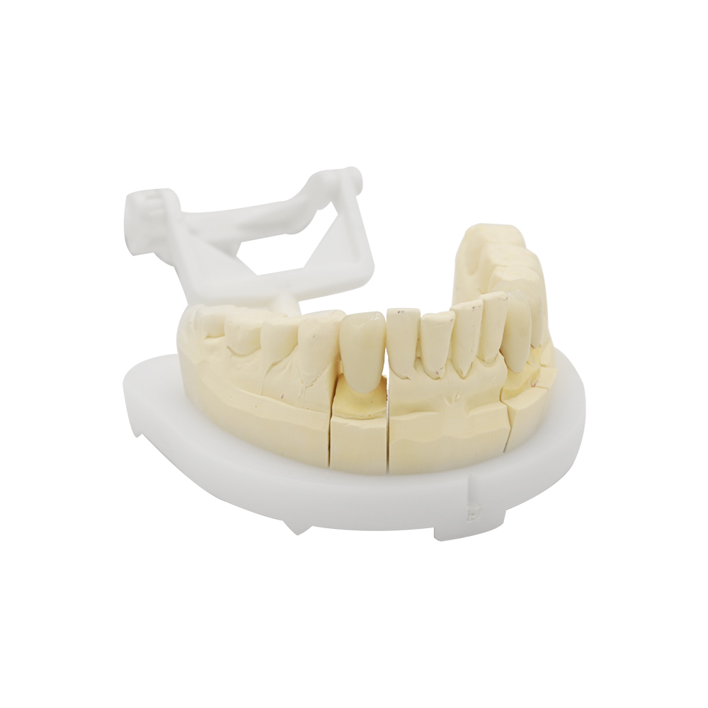 Corona e ponte in zirconia a contorno completo (1)
