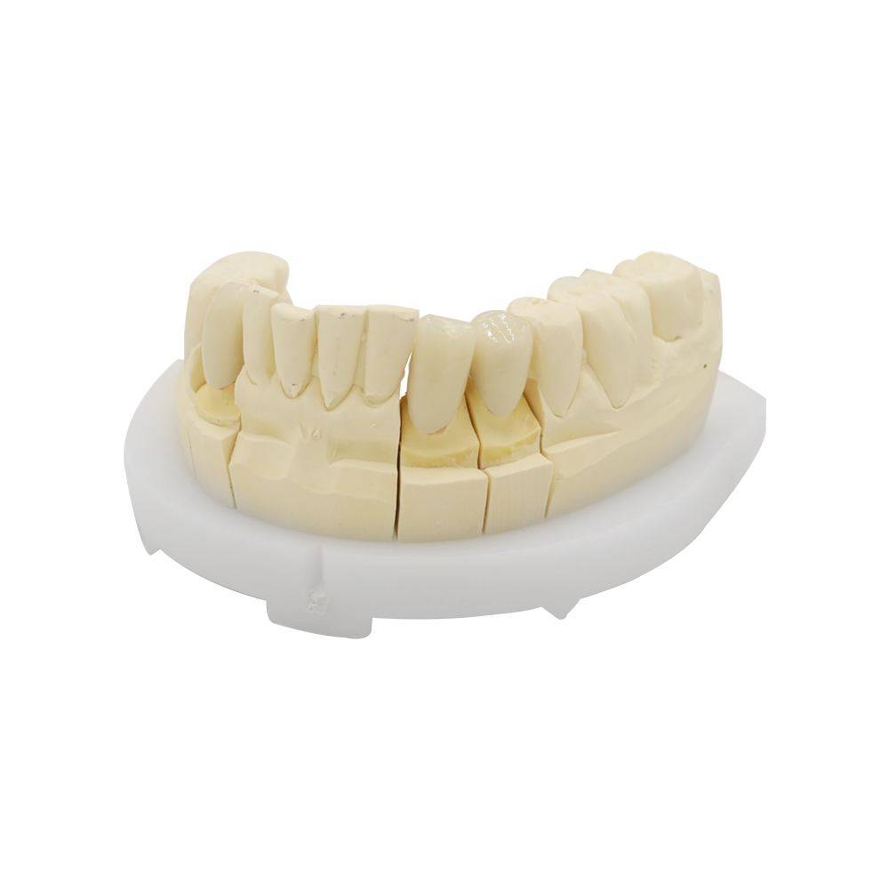 Corona e ponte in zirconia a contorno completo (2)