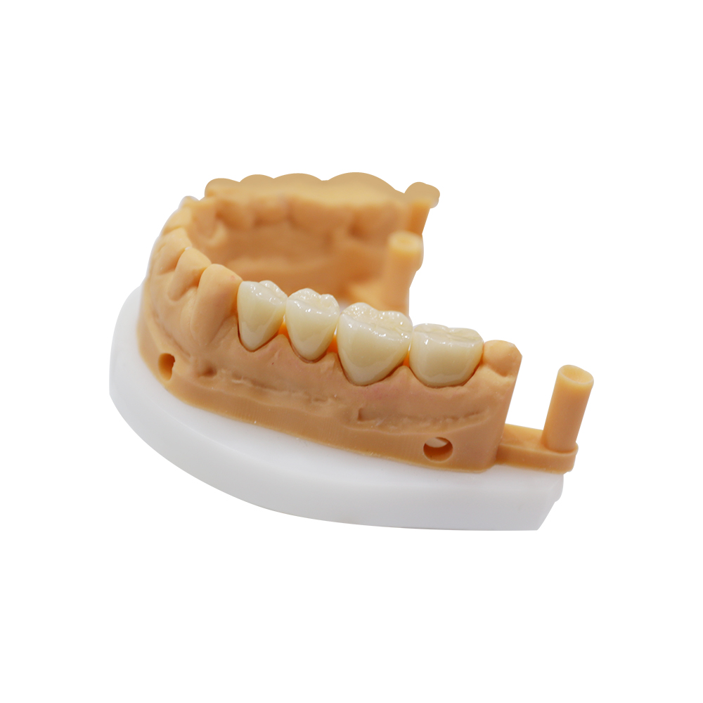 Corona e ponte in zirconia a contorno completo (3)