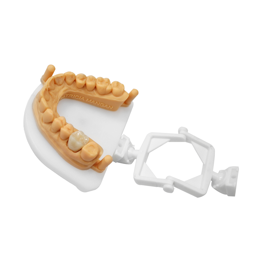 Corona e ponte in zirconia a contorno completo (4)