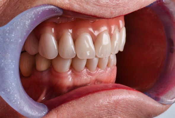 Identificering af ideelle kandidater til Istar's implantater til øvre og nedre tandproteser