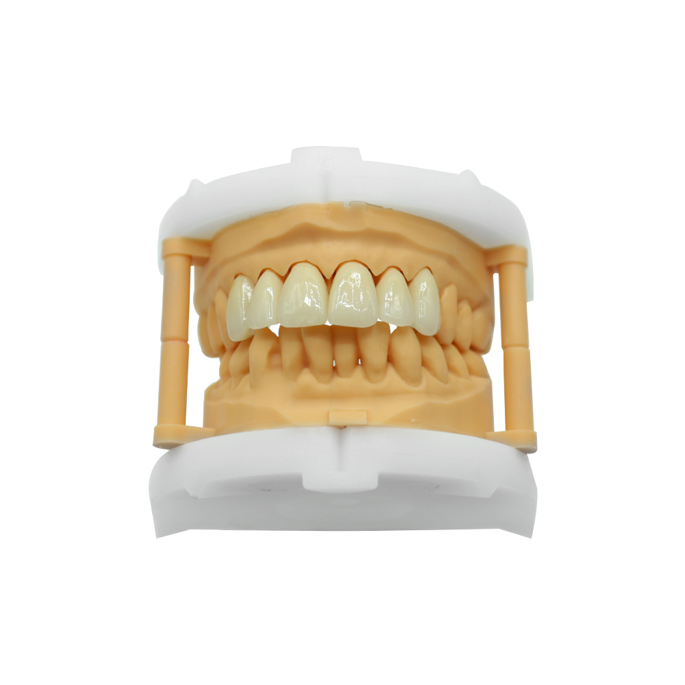 Geschichtete Zirkoniumdioxid-Krone und -Brücke (3)