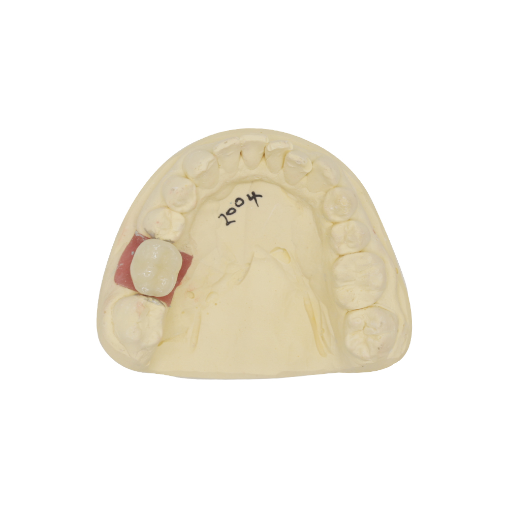 PFM 임플란트 크라운 (2)