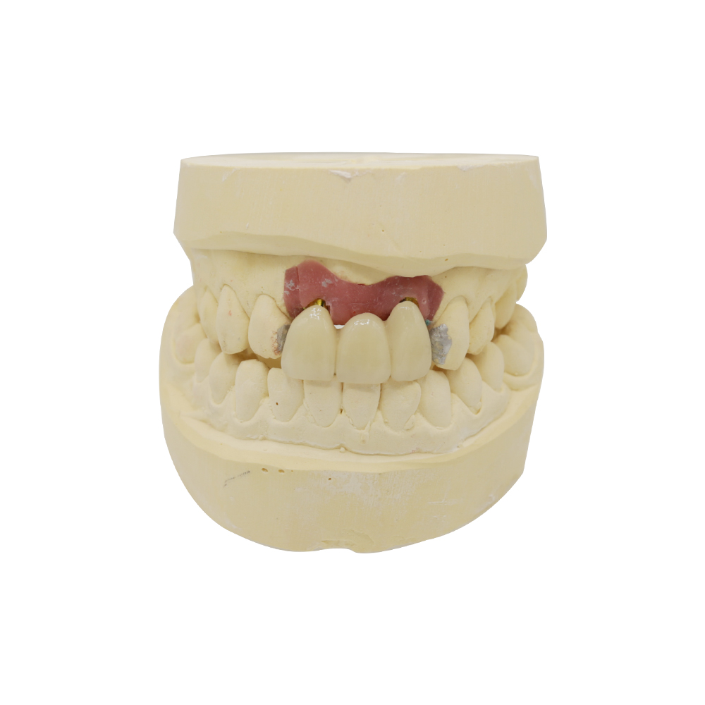 PFM 임플란트 크라운 (3)