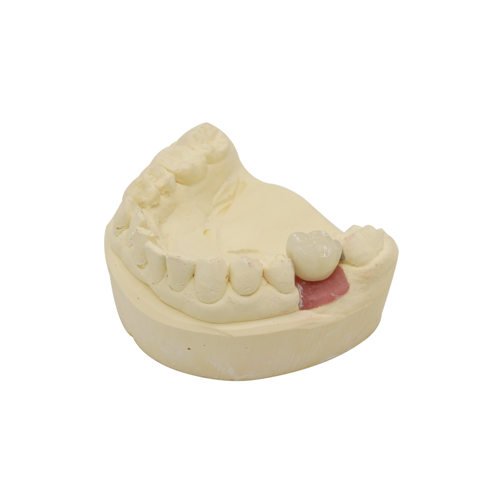 PFM 임플란트 크라운 (4)