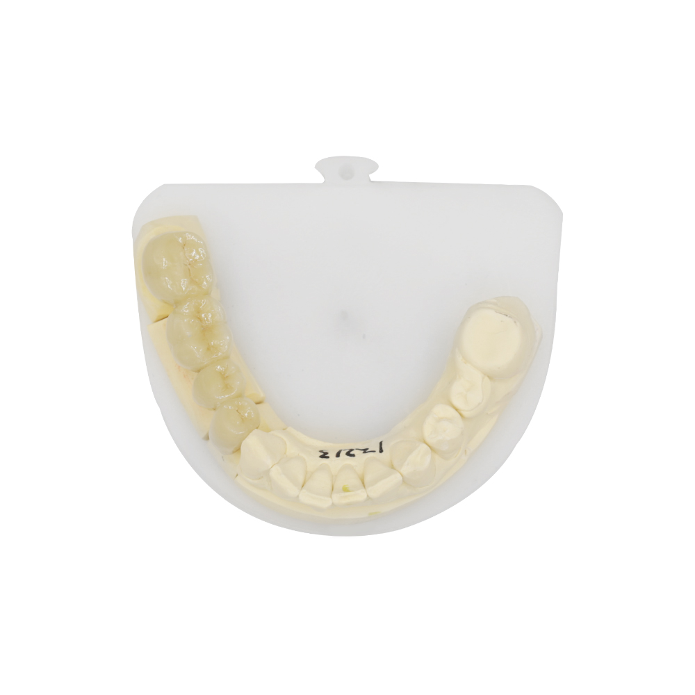 후방 PFM 브리지 (1)