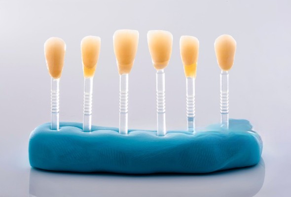Avantages supérieurs des facettes Emax