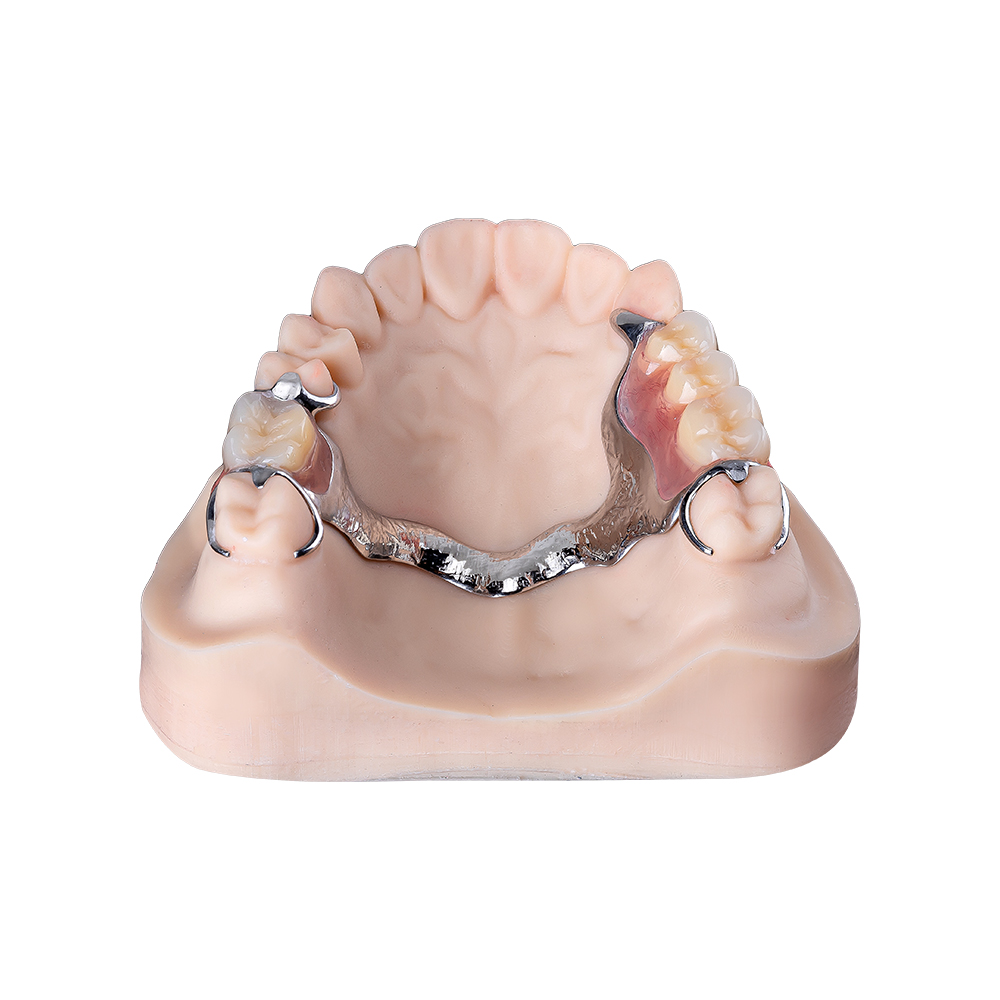 Protesi metalliche superiori (1)