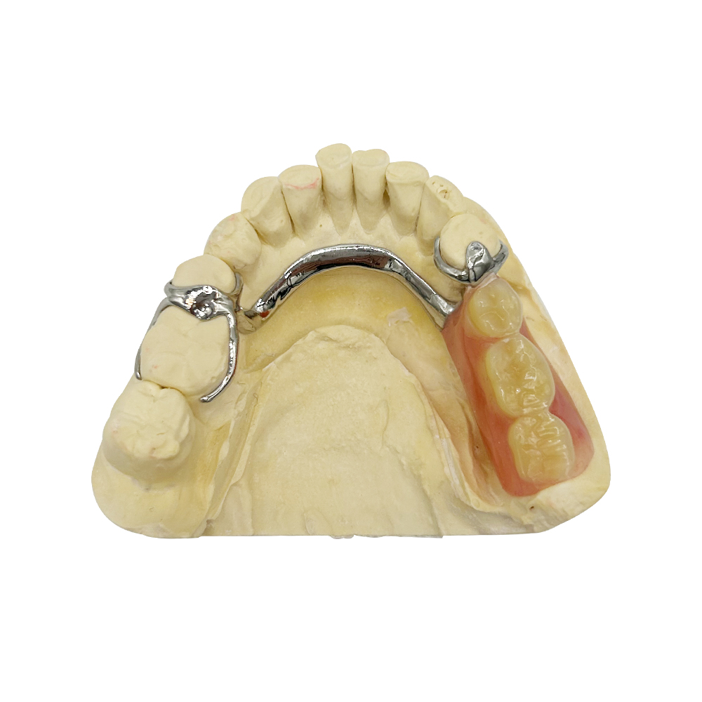 Prothèses dentaires Vitallium (4)