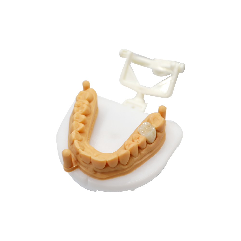 Zirkoniumdioxid-Krone für Seitenzähne (3)