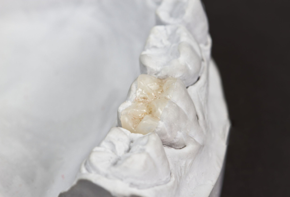 Avantages des inlays et onlays en céramique par rapport aux restaurations traditionnelles