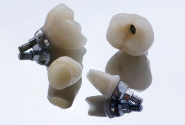 Vantaggi clinici delle corone implantari avvitate