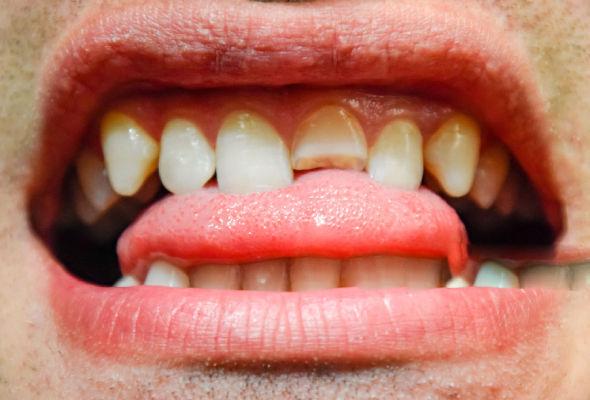 Applicazioni cliniche delle faccette in composito