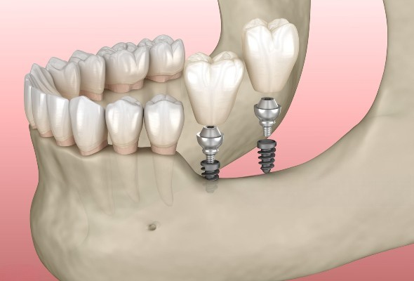 Klinische Anwendungen von Mini-Dentalimplantaten