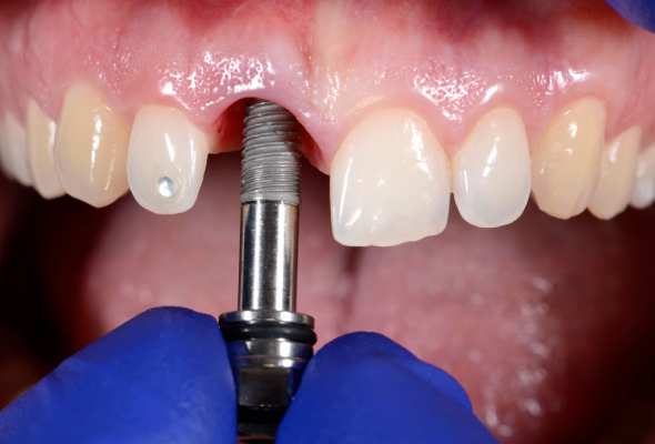 Consideraciones clínicas en casos de implantes unitarios