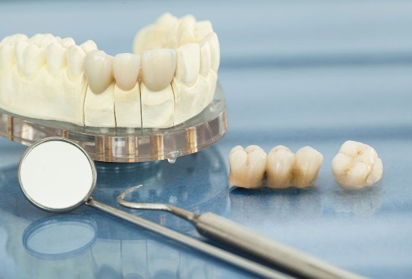 Wskazania kliniczne dla przednich mostów PFM