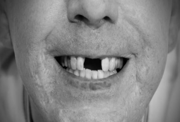 복잡한 앞니 임플란트 케이스를 위한 임상 솔루션 (1)