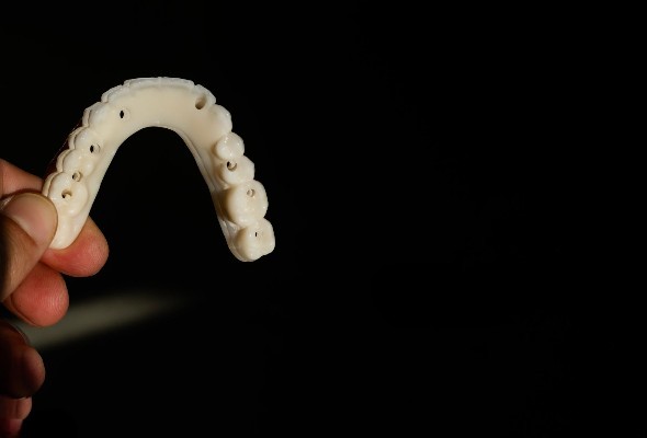 Erwägungen für Mini-Dentalimplantat-Versorgungen