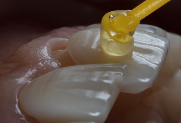 Ideal Applications for Zirconia Veneers_ Clinical Indications